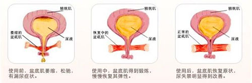 盆底肌修复训练图