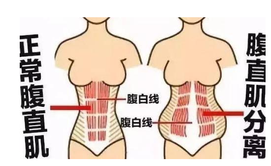 腹直肌修复