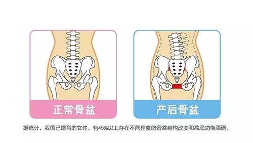 正常骨盆和产后骨盆的区别示意图