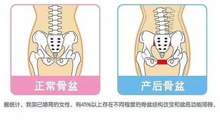 正常骨盆对比产后骨盆