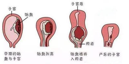 产后子宫饿产前子宫对比