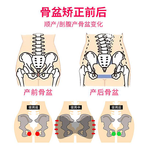 产后骨盆矫正前后