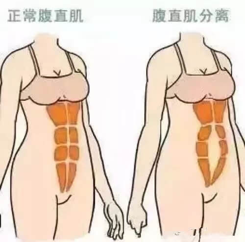 腹直肌分离前后图