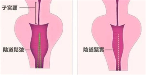 盆底肌电疗10次能变紧么？揭秘10次疗程的真实改善|产后妈妈