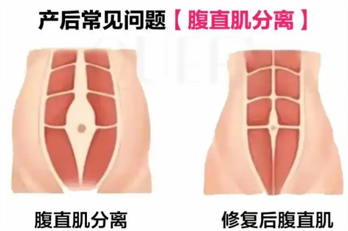 腹直肌修复.jpg