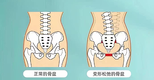 骨盆修复.jpg