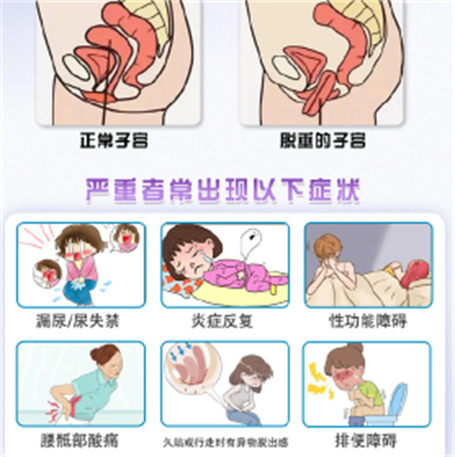 子宫脱垂的症状.jpg