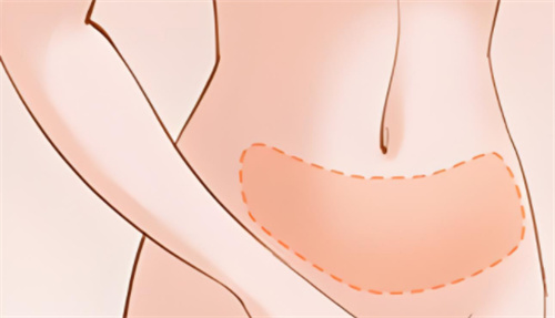 吸脂腹部区域.jpg