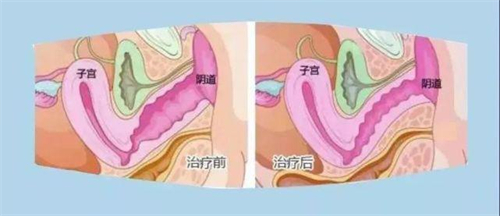 缩阴手术前后对比动画图.jpg