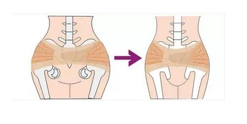 阴道紧缩手术盆骨前后对比图.jpg