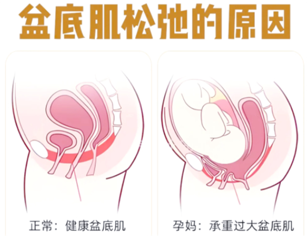盆底肌松弛的原因.jpg