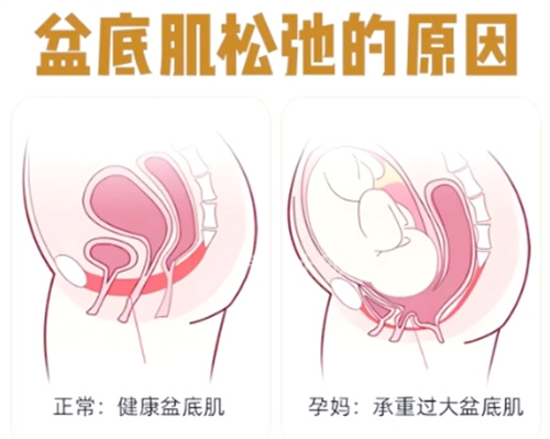 盆肌底松弛的原因.jpg