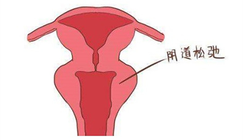 阴道松弛动画演示图.jpg