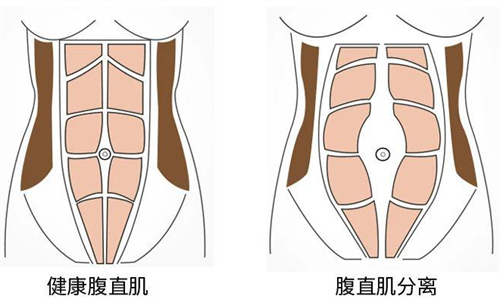 腹壁成形术前后腹直肌的变化图解.jpg