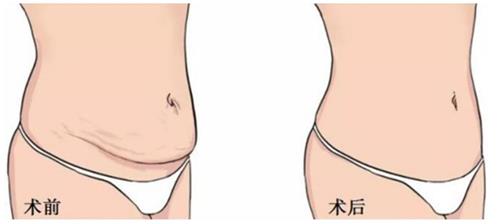 美人鱼腹壁成形手术前后的区别.png