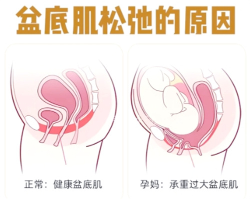 盆肌底松弛的原因.jpg