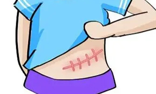剖腹产该做哪些产后修复?骨盆→盆底肌→腹直肌三阶攻略,疤痕修复也必不可少!