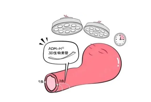 3d生物束带缩阴.png