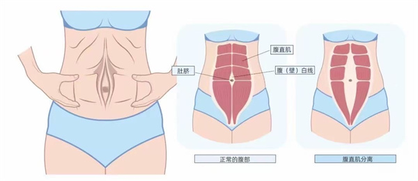 腹直肌分离解析图