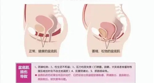 光电疗法修复盆底肌靠谱吗？结果好小创口伤改善快真实体验值得新手信赖