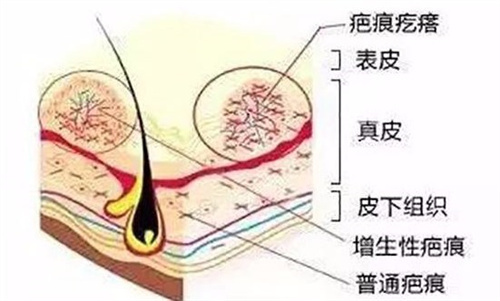 剖腹产产后修复必做的项目有哪些？疤痕修复、盆底肌修复、腹直肌修复