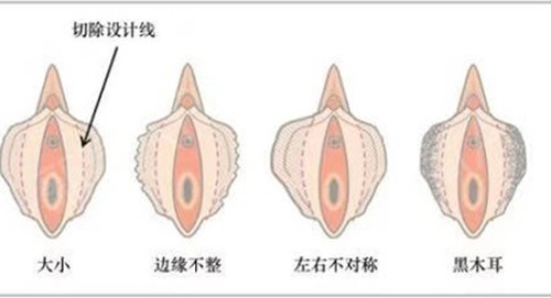 产后阴道松弛应该做阴道紧缩手术还是做激光缩阴？科学选择指南！