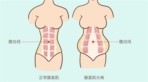 腹直肌分离对比 腹直肌分离对比