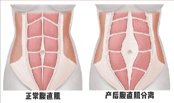 腹直肌分离 腹直肌分离