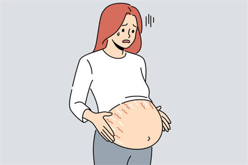 产后妊娠纹怎么可以消除？生小孩肚子上妊娠纹怎么去除？