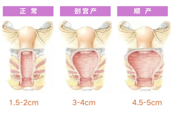 正常阴道和松弛对比照片