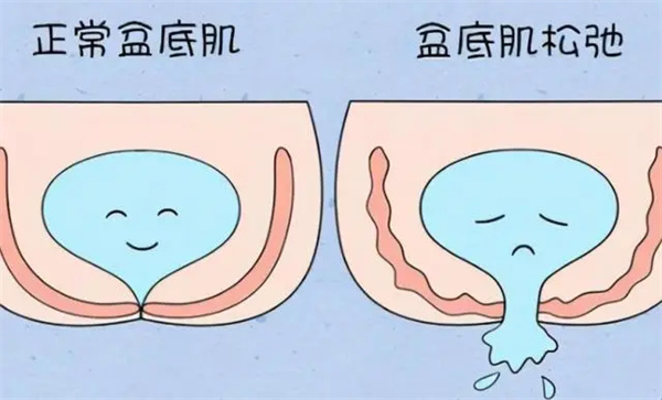 产后修复盆底肌靠谱吗？从原理到实际成效，紧致改善真相全解析