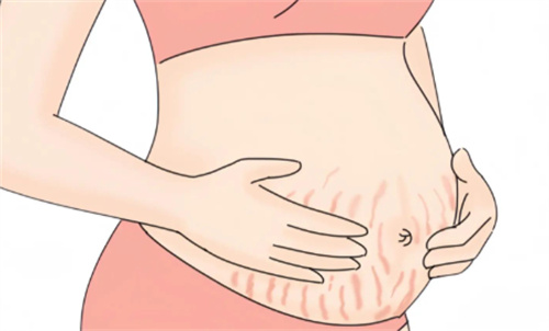 产后妊娠纹很痒很痒怎么办?丑就算了还痒,能用激光打吗？