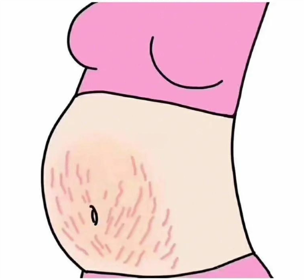 妊娠纹