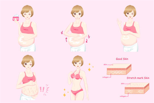 妊娠纹治疗漫画示意图