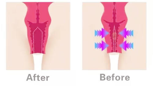 产后阴道松弛怎么修复紧致?阴道紧缩术一劳永逸|可直接缩小阴道直径|紧致阴道内壁