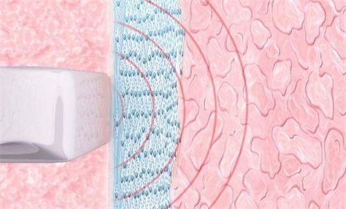 阴道紧缩原理 阴道紧缩原理