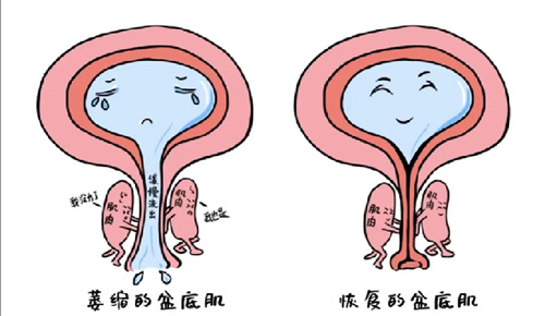 盆底肌对比 盆底肌对比