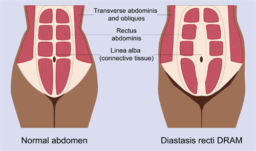 腹壁成形改善腹直肌