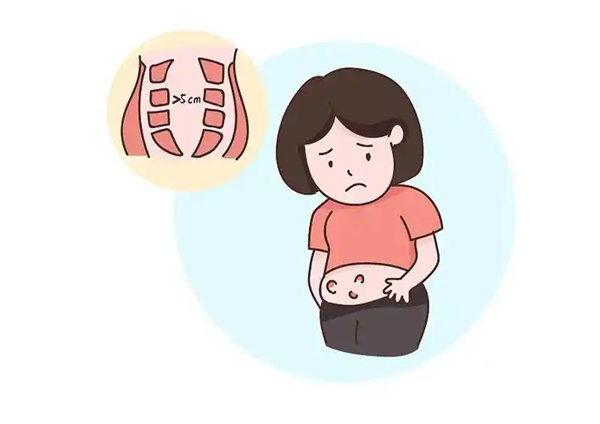 腹直肌分离图片