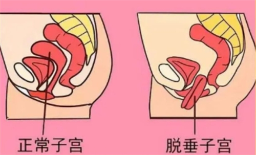 产后修复是去医院做好还是外面的机构做好？有撕裂/脱垂选医院，身材塑形机构更懂审美和细节！