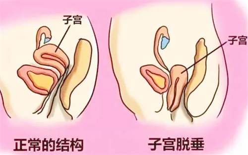 子宫脱垂对比