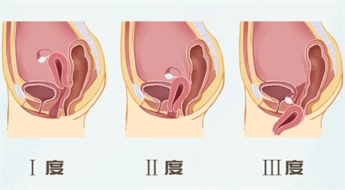 子宫脱垂一二三度对比图