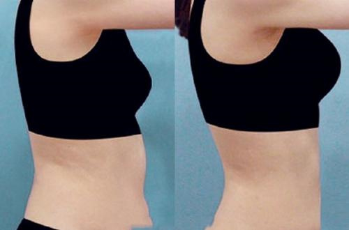 腰腹部吸脂手术前后对比图